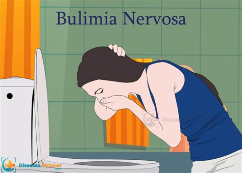 bulimia nervosa-4